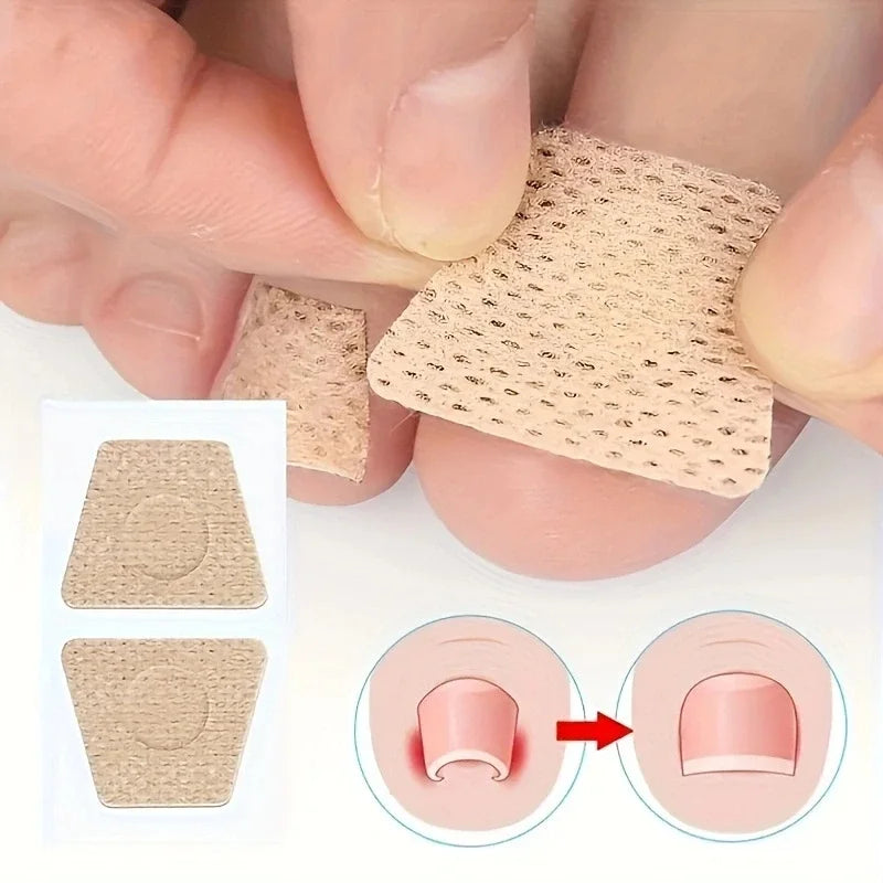Nail Repair Patch Grey Fungal Nails Thickening Soft Paronychia Treatment Anti Infection Correction Sticker Ingrown Toenail Care